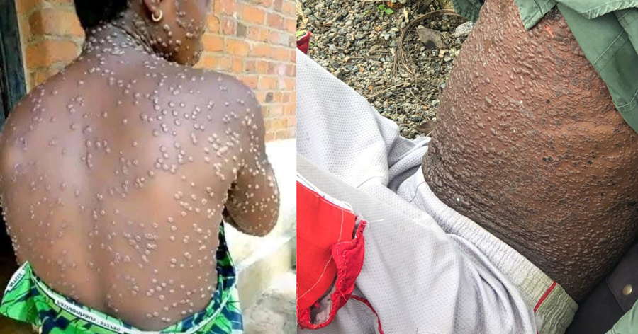 Sierra Leone Confirms 102 New Mpox Cases, Total Reaches 2,147
